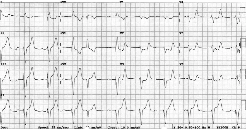 TOP-100-ECG-QUIZ-LITFL-045.jpg