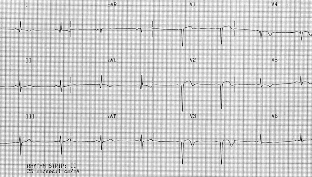ECG-Ventricular-Aneurysm.jpg