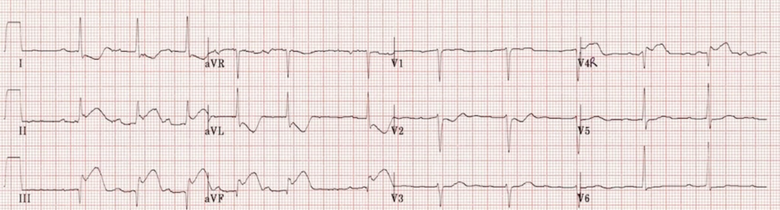 ECG 1.png