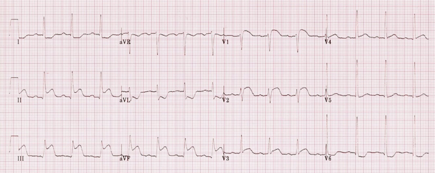 ECG 2.png