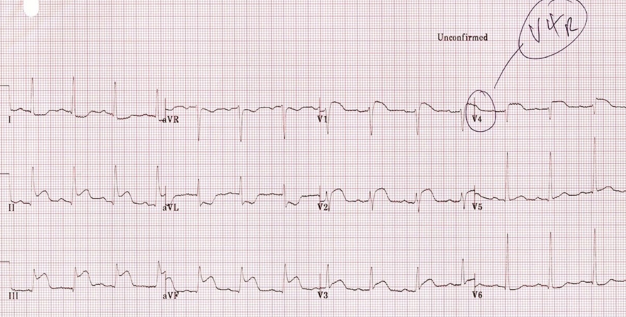 ECG 3.png