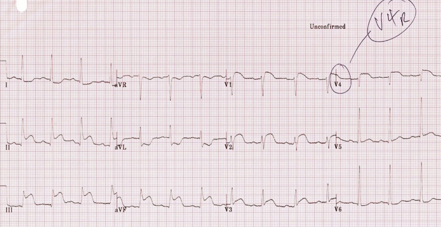 ECG 4.png
