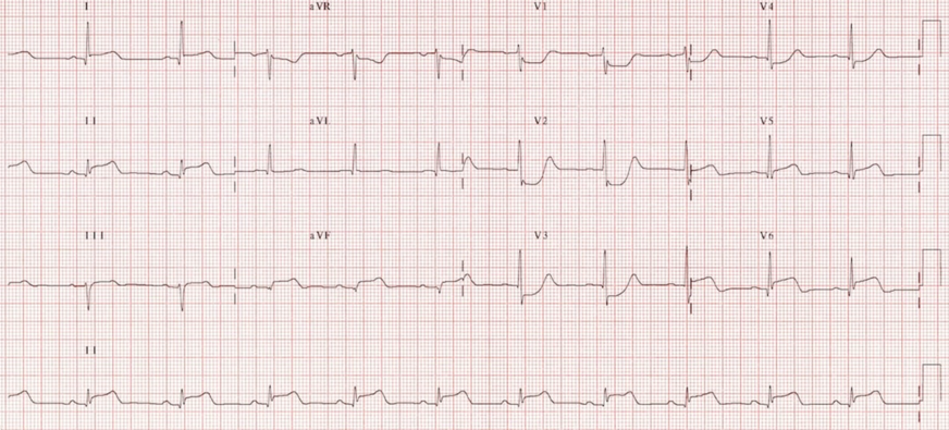 ECG 5.png