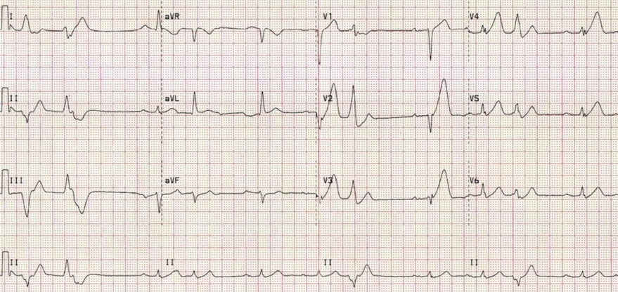 ECG 6.png