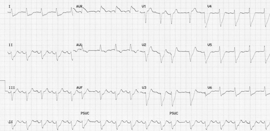 ECG 7.png