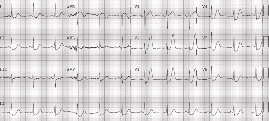 ECG 8.png