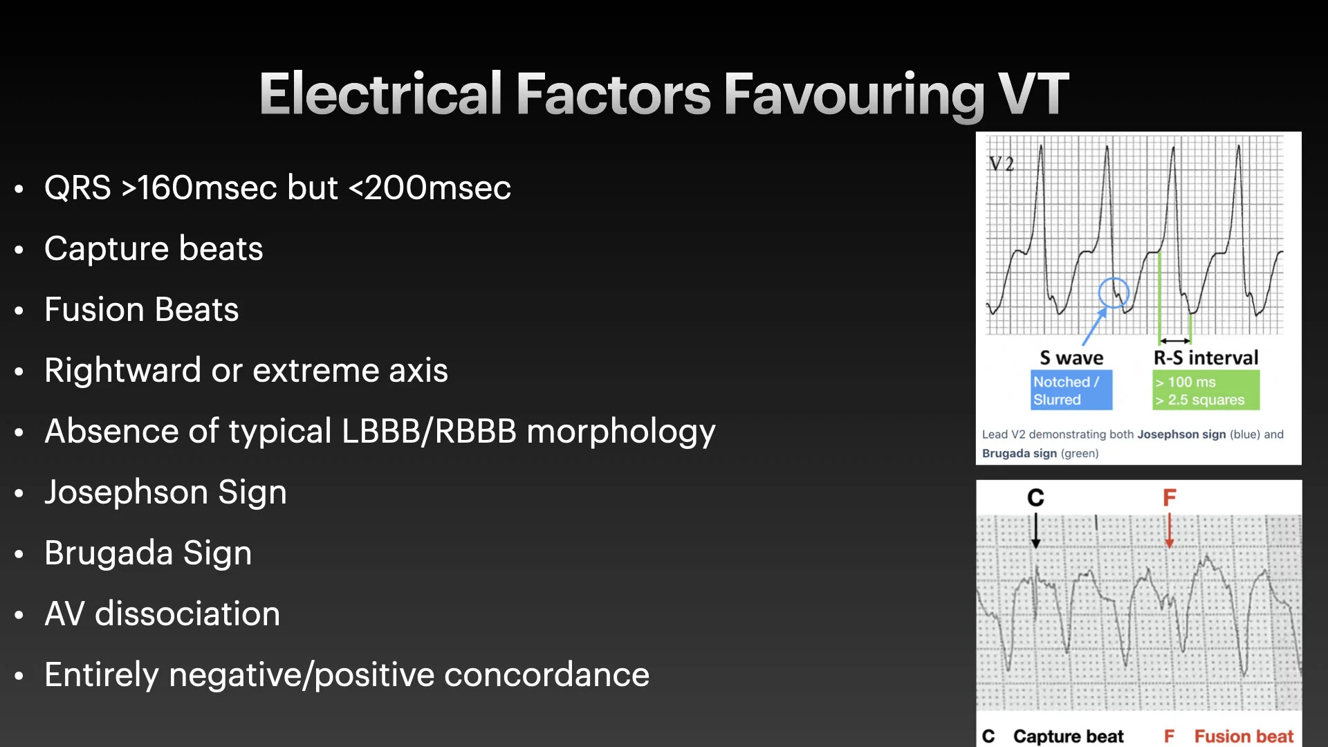 Broad Complex tachyarrhythmias.005.jpg