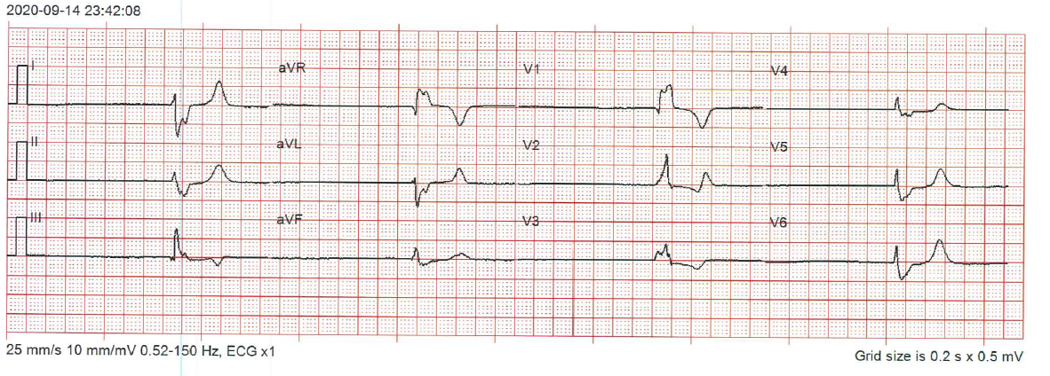ECG of the week 30 sept.PNG