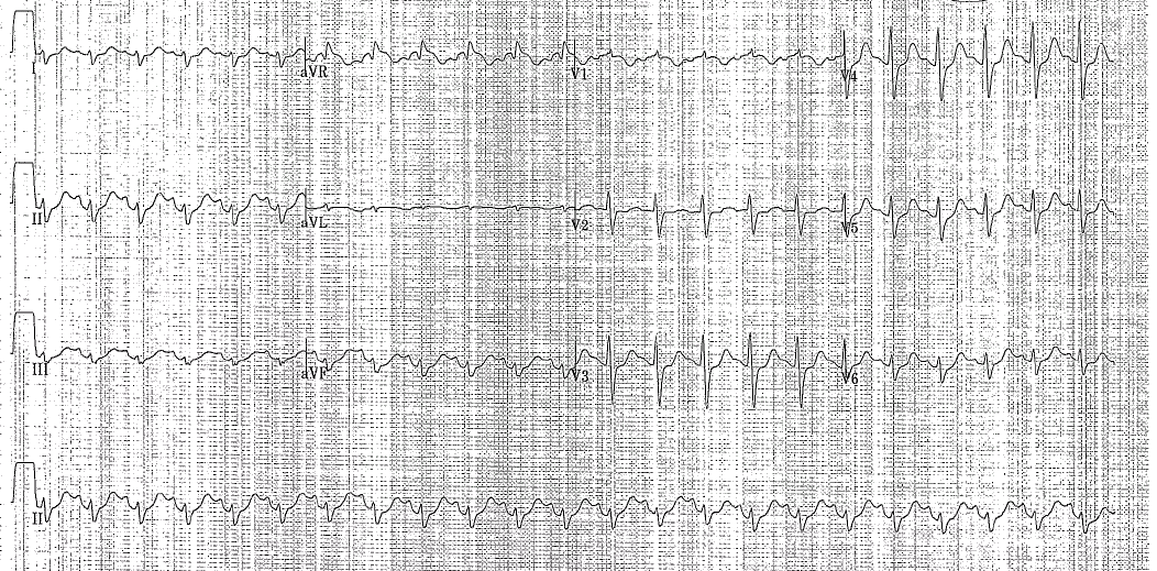 ECG of the week.PNG