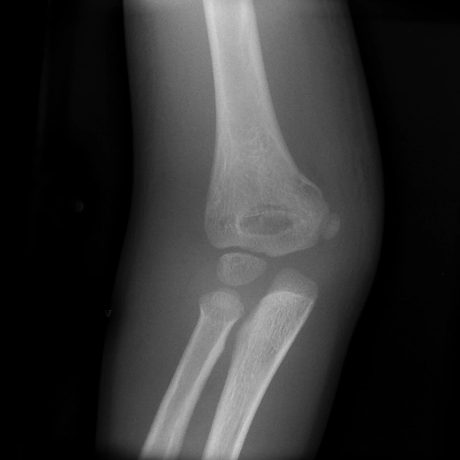 supracondylar-fracture-minimally-displaced (2).jpg