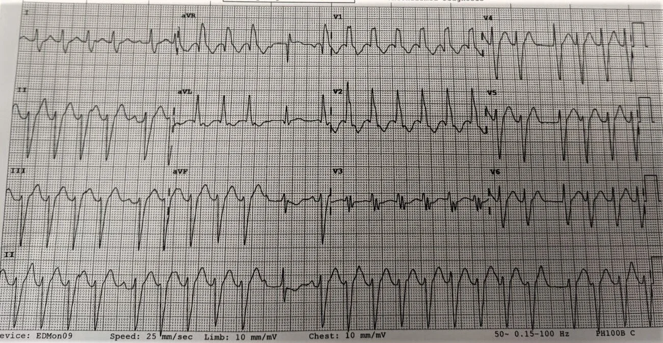Describe the ECG.Wide complex tachycardia at 140-150bpmIrregular rhythmLeft axis deviation with RBBB (i.e. bifascicular – LAFB + RBBB)P waves are intermittently present (see 5th beat in limb leads)Prolonged QT intervalAnterior T wave inversion (V1 a…