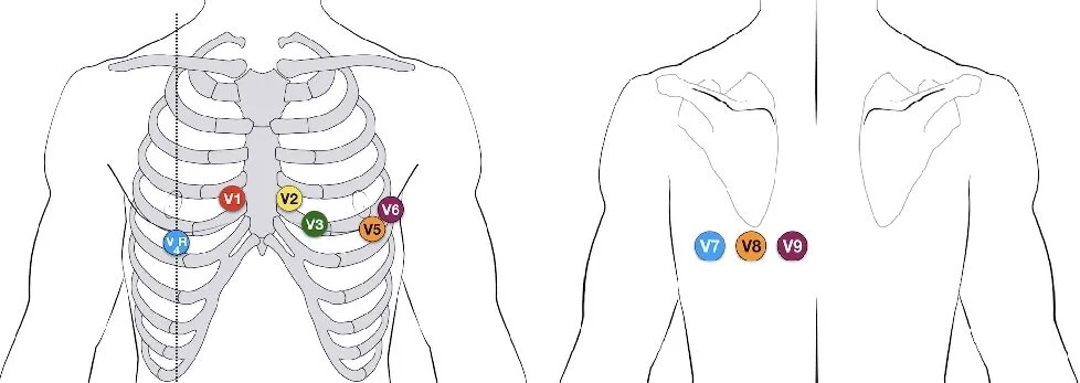 V4R-ECG-lead-placement.jpg