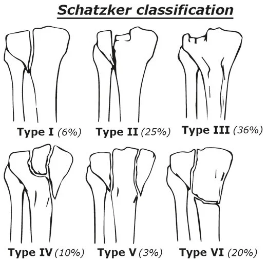 Schatzker knee classification.jpg