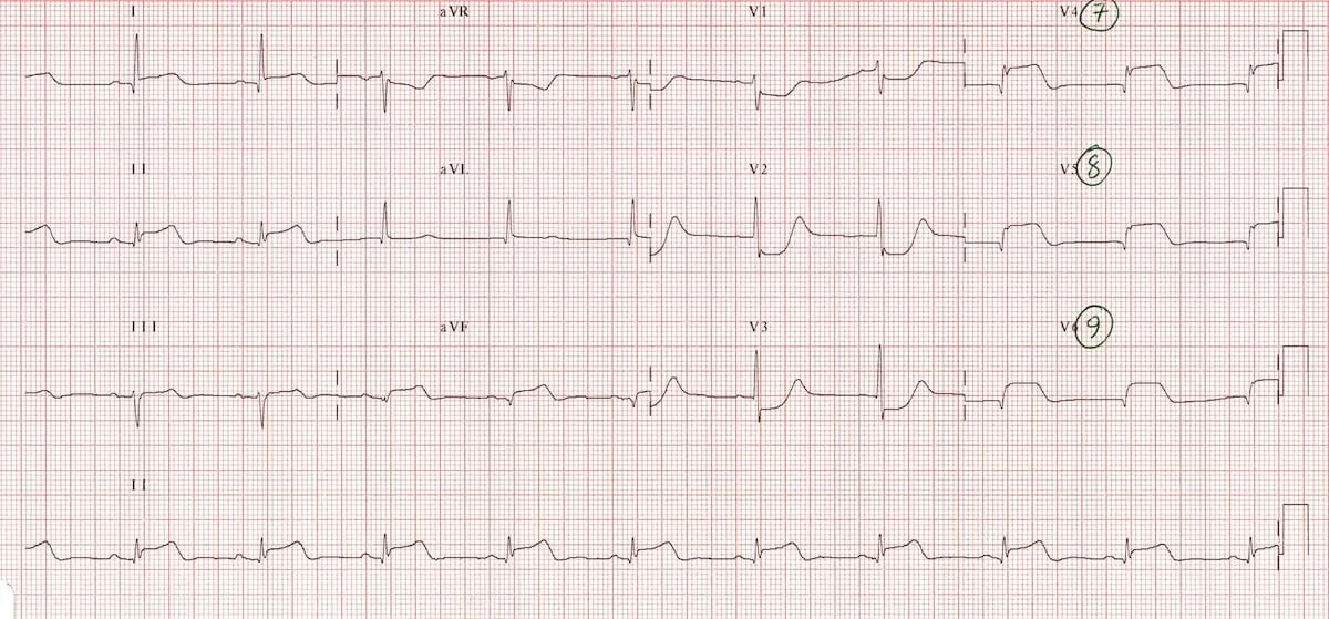 ECG-Posterior-AMI-1b-V789.jpg