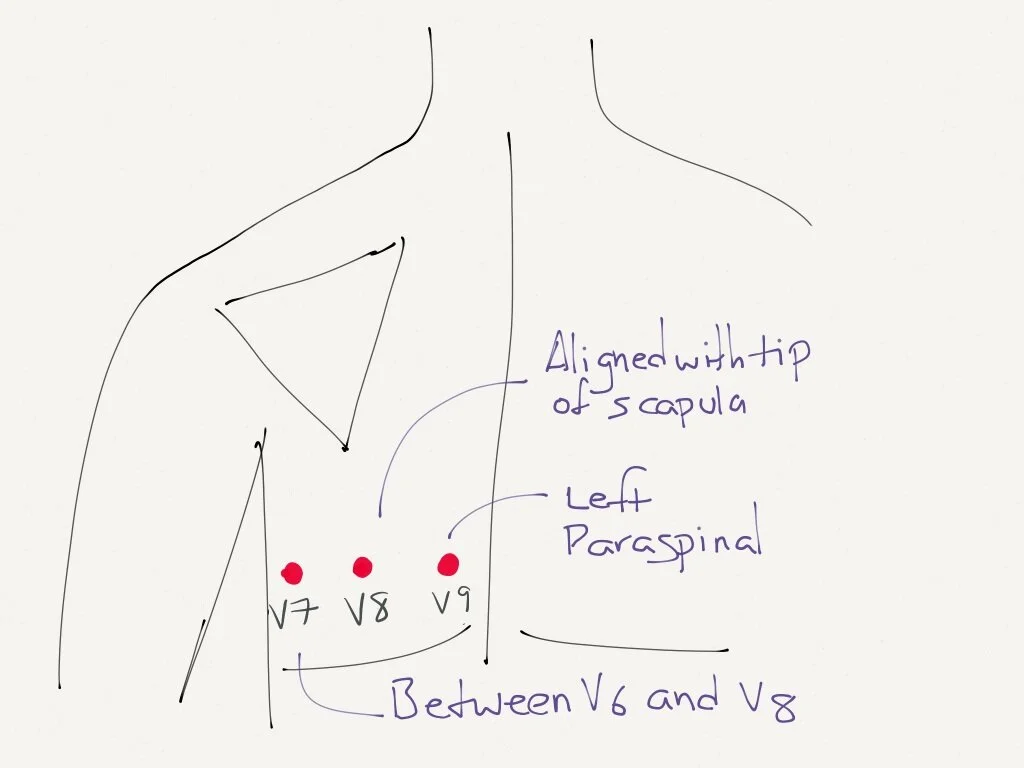 PosteriorECGLeadPlacement (1).jpg