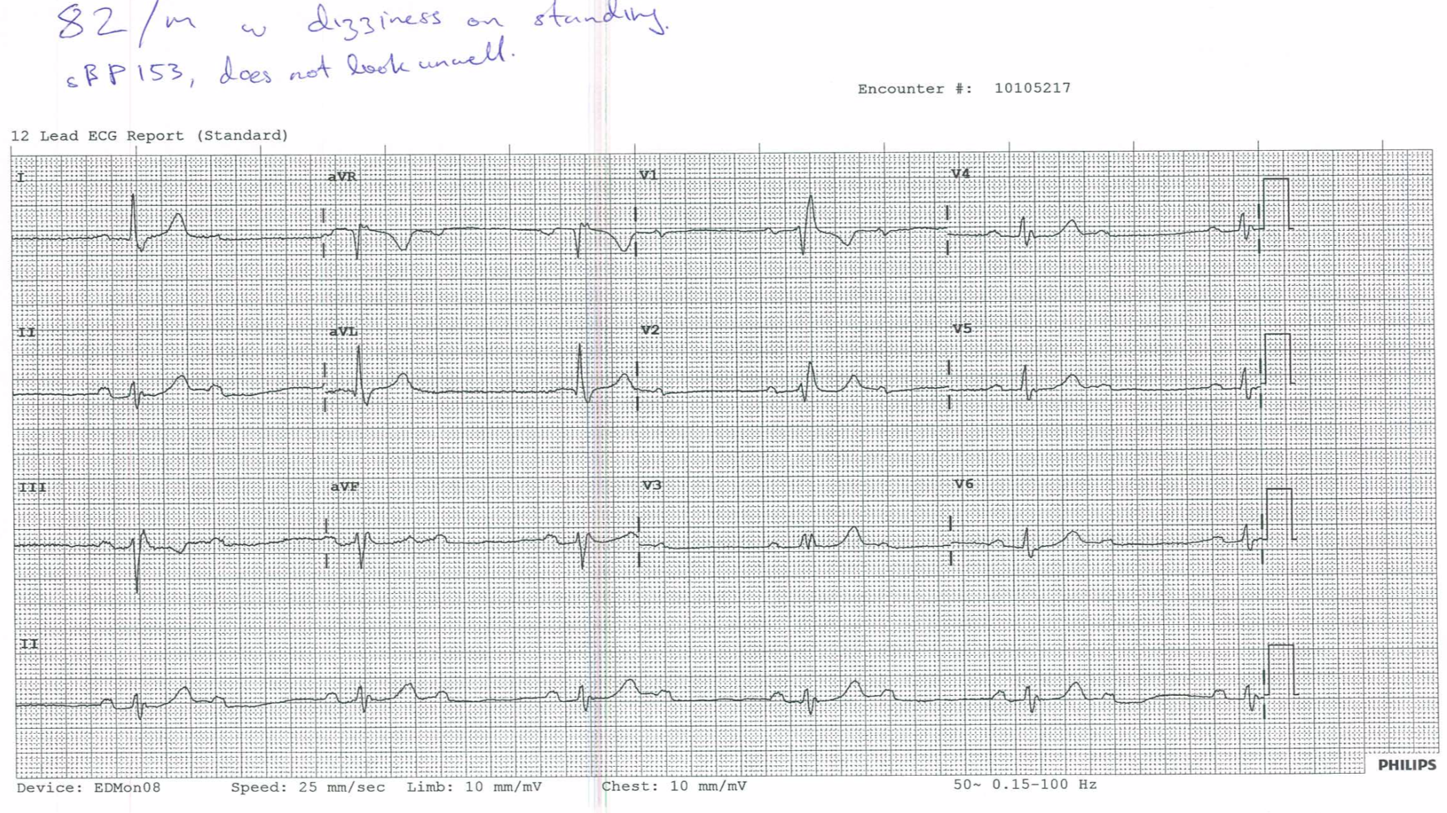 1) Describe the ECGBifascicular block (RBBB and left anterior fascicular block)1st degree AV blockNOTE: Left anterior fascicular block consists of:Left axis deviationUpward QRS (qR complex) in Lead I and aVLDownward QRS (rS complex) in inferior leadsProlonged R wave peak time in aVL > 45ms (i.e. time from Q to peak of R wave is > 1 small box)