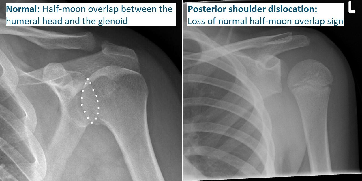 Loss of normal half-moon overlap sign — the glenoid fossa appears vacant due to lateral displacement of the humeral head