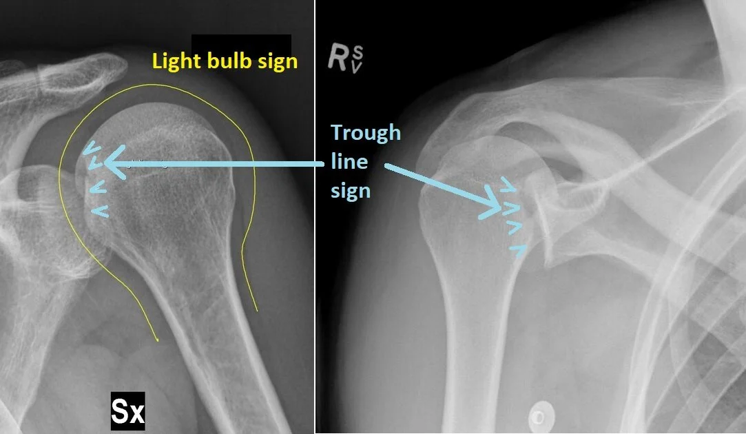 Light bulb sign — the humeral head is internally rotated, resembling a “light bulb”Trough line sign — two nearly parallel lines in the superomedial aspect of the humeral head