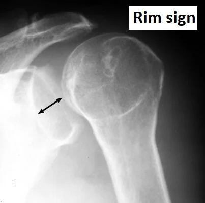 Rim sign — widened glenohumeral joint > 6 mm