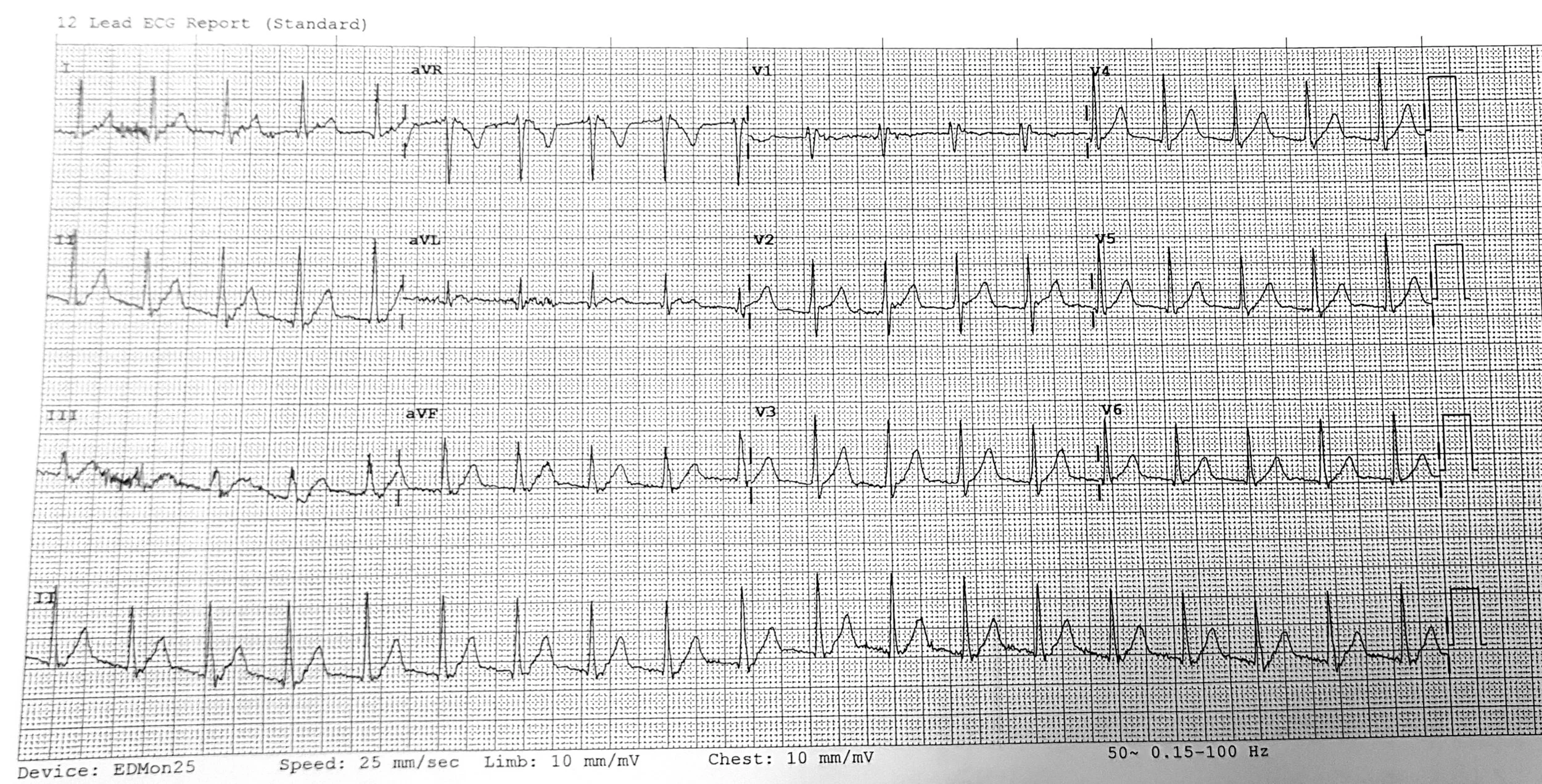 lLink to ECG of the Week talk: https://vimeo.com/586729999/5b25ddda8d