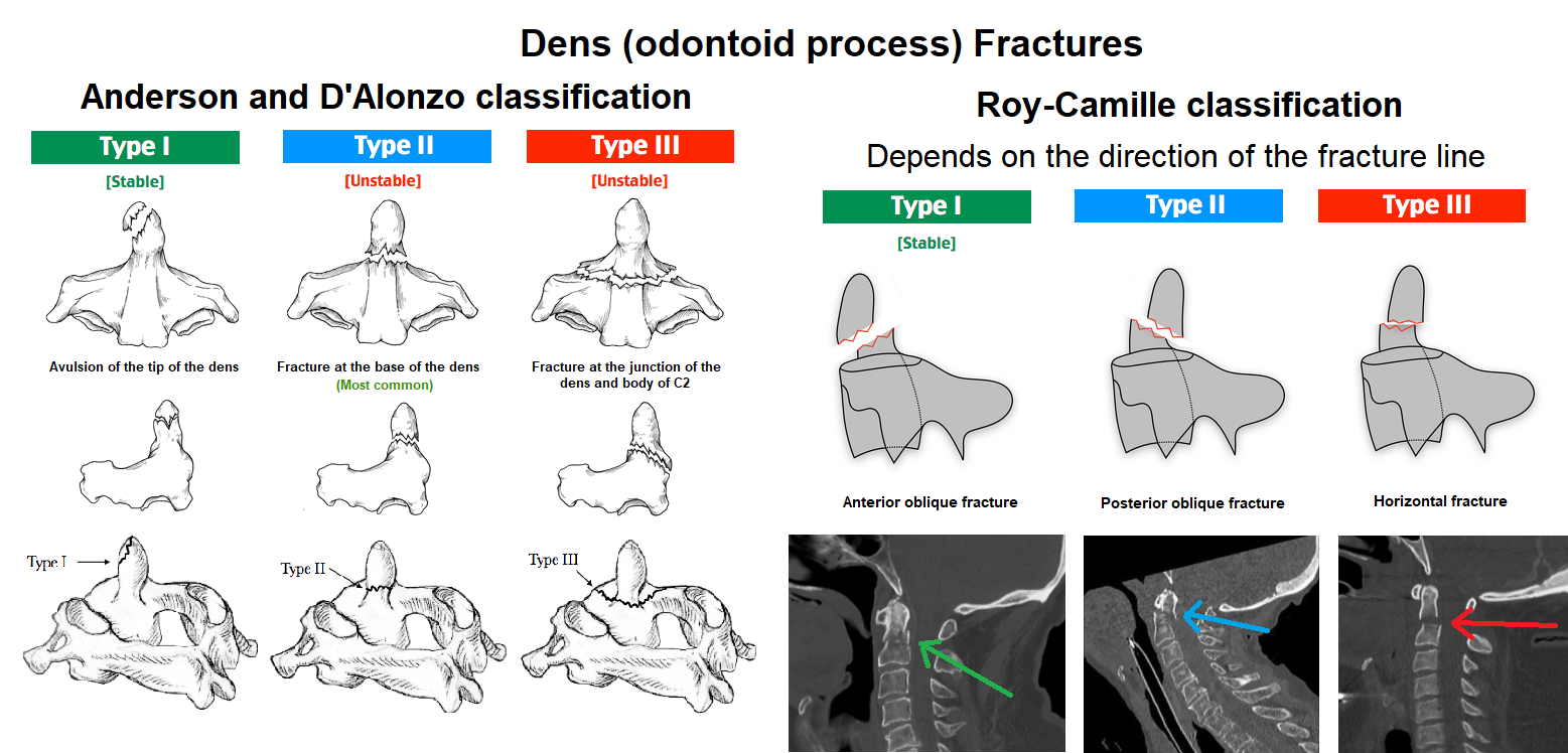 Odontoid fractures.png