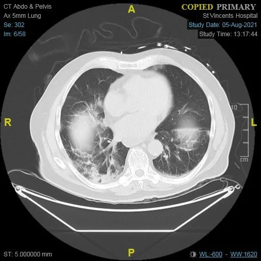 gallstone lung.jpg