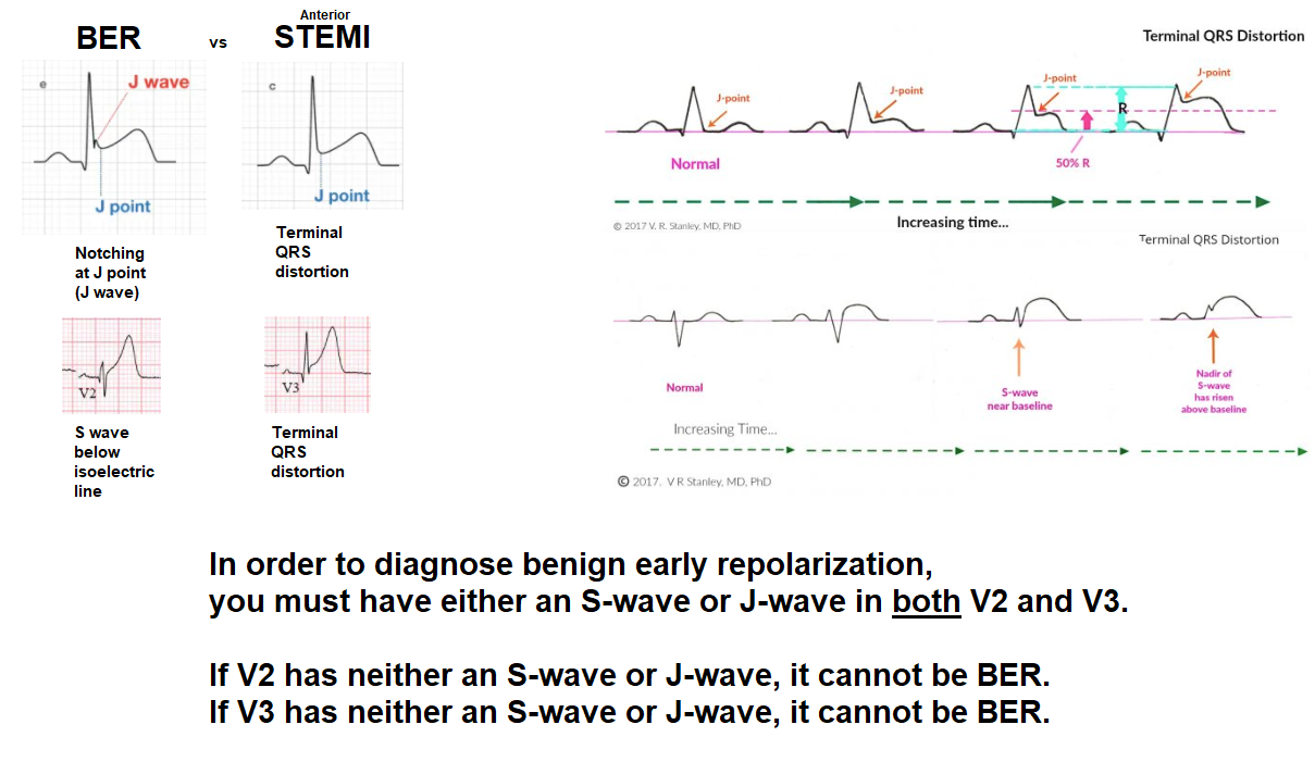 BER vs anterior STEMI.png
