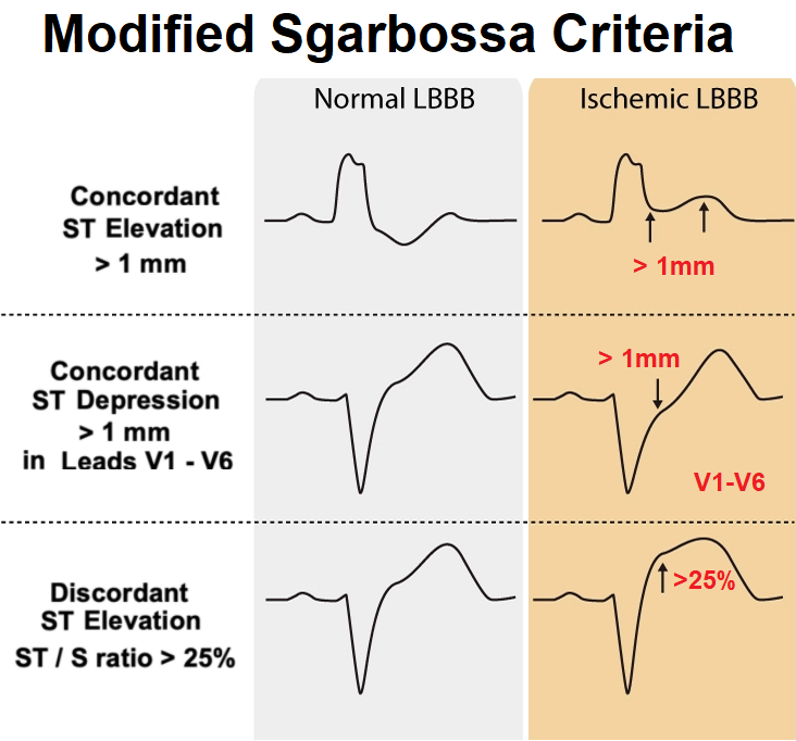 For patients with pre-existing LBBB or pacemaker
