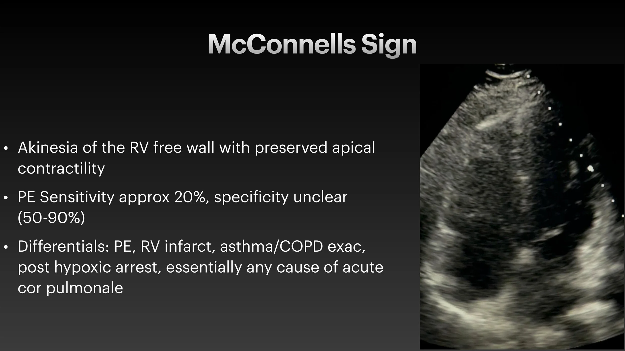 PE echo and ECG presentation-11.jpg