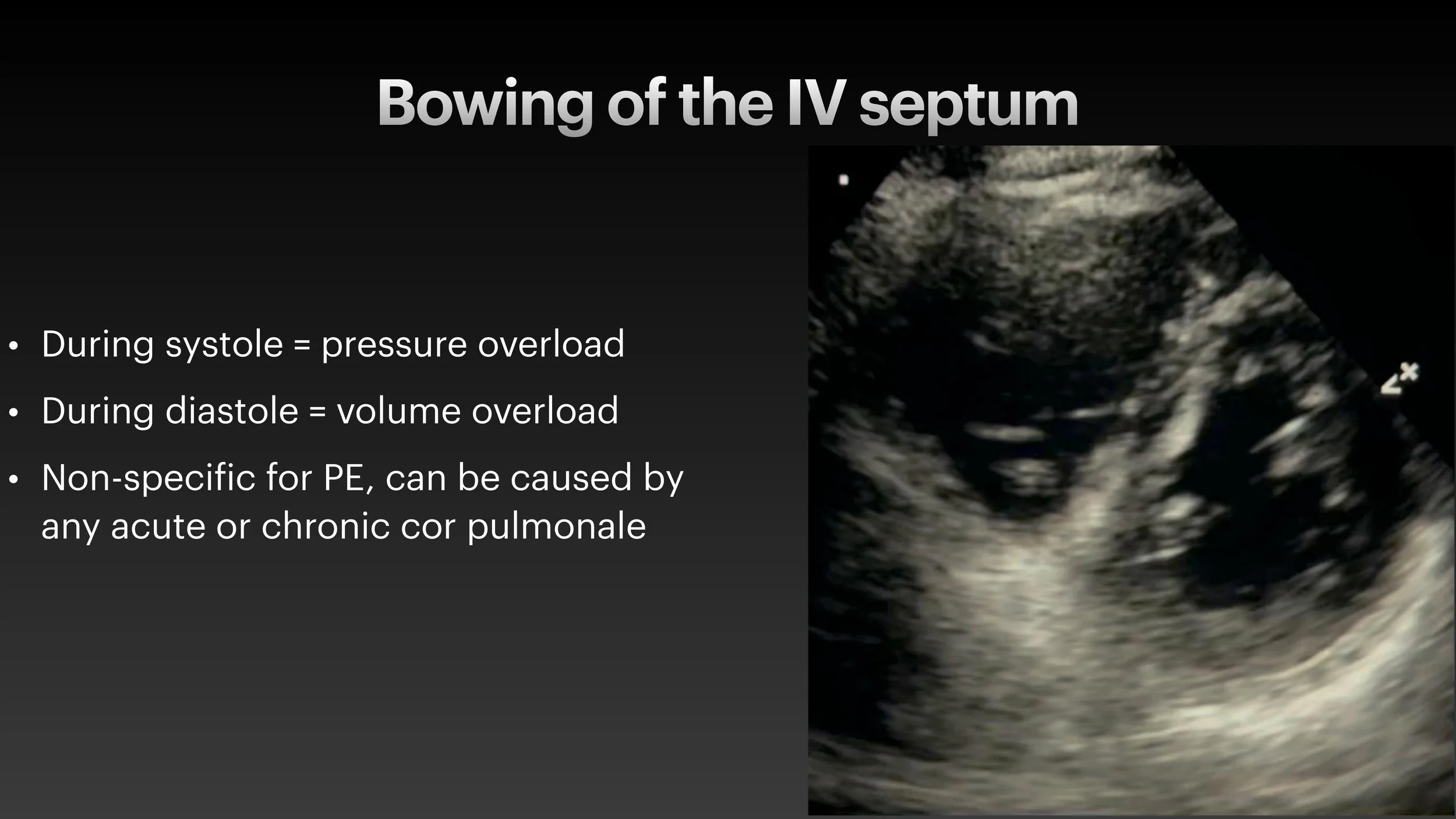 PE echo and ECG presentation-12.jpg
