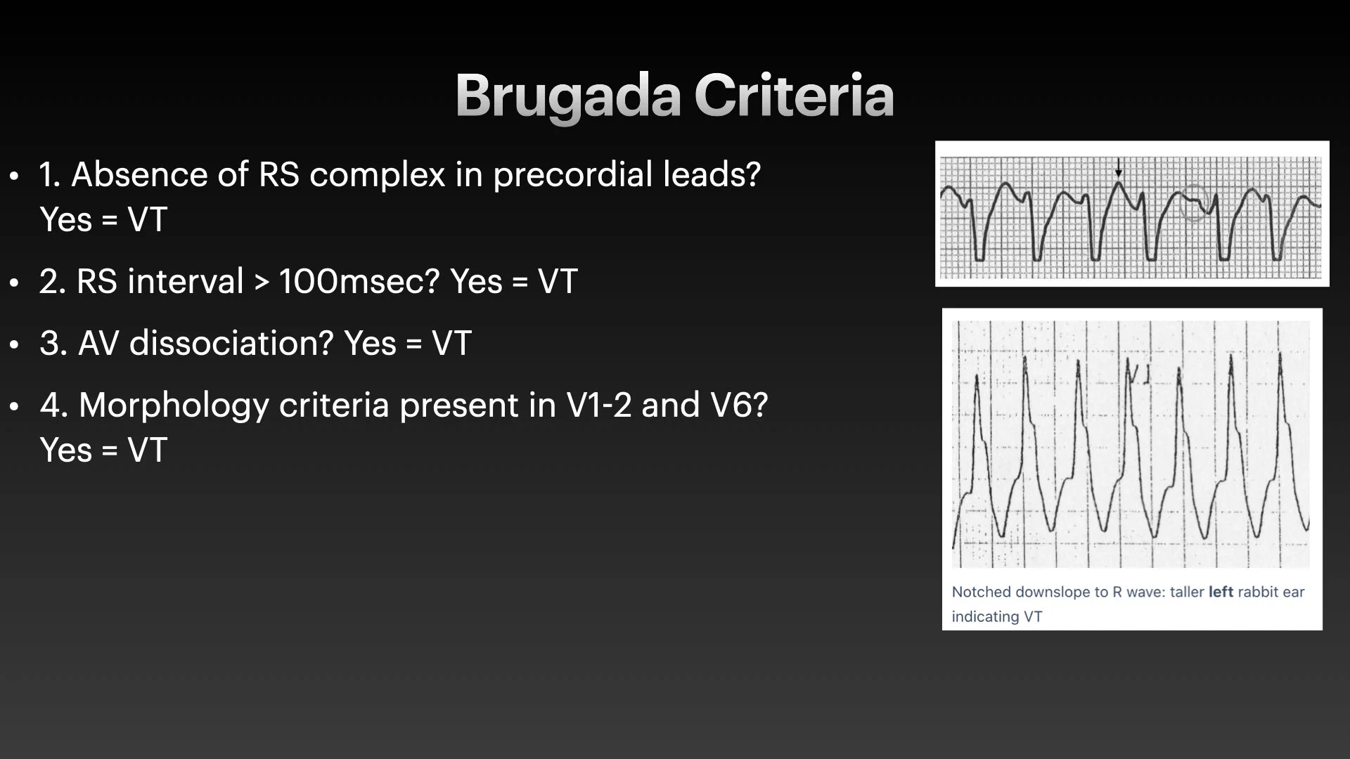 Broad Complex tachyarrhythmias.006.jpg