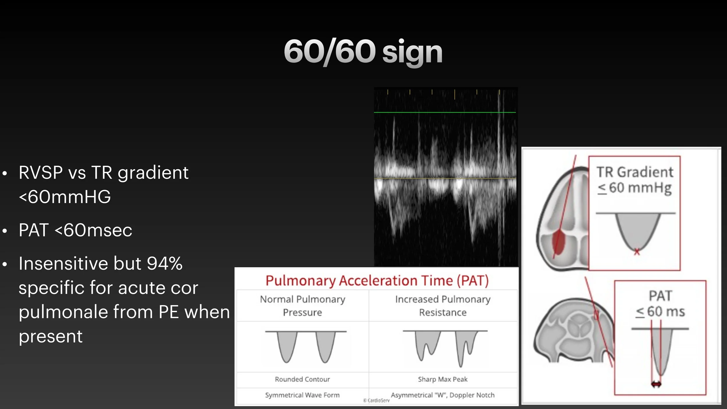 PE echo and ECG presentation-13.jpg