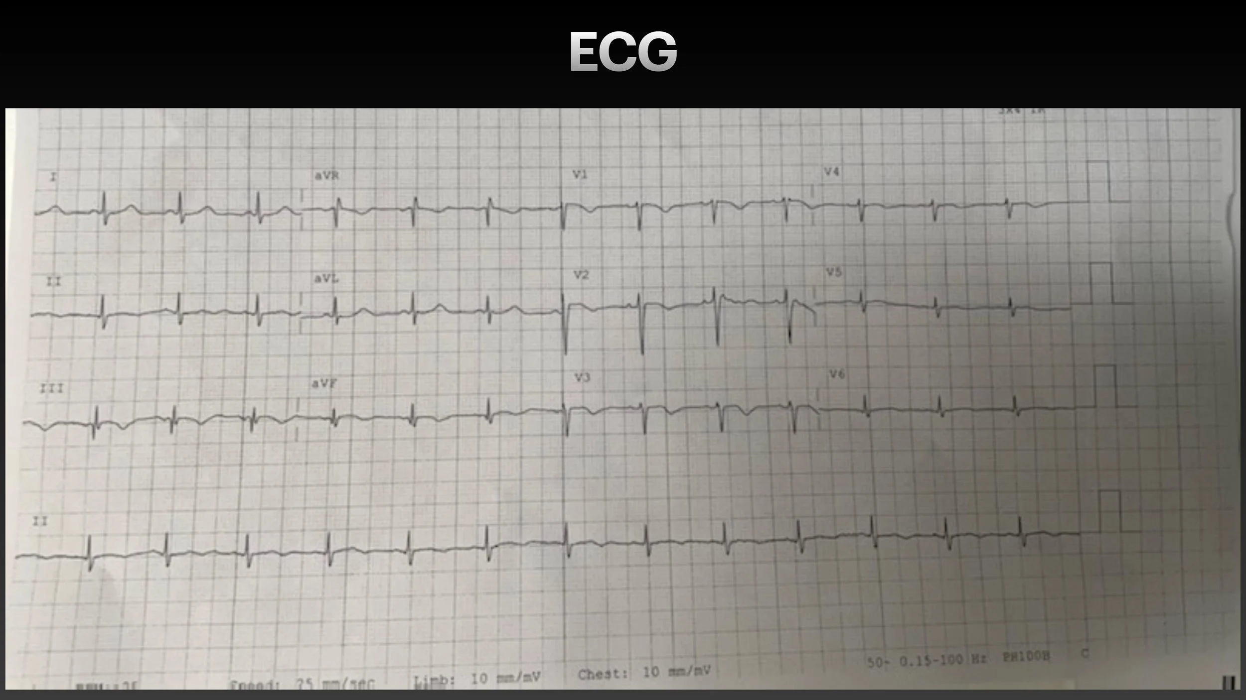 PE echo and ECG presentation-3.jpg