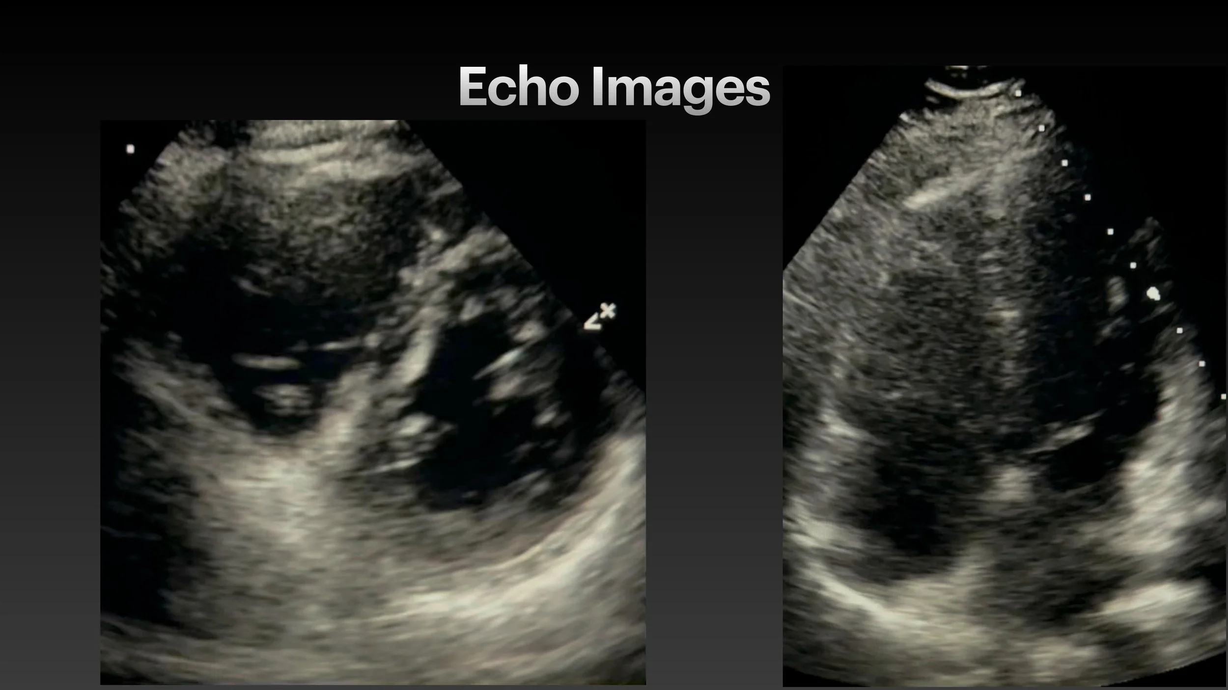 PE echo and ECG presentation-9.jpg