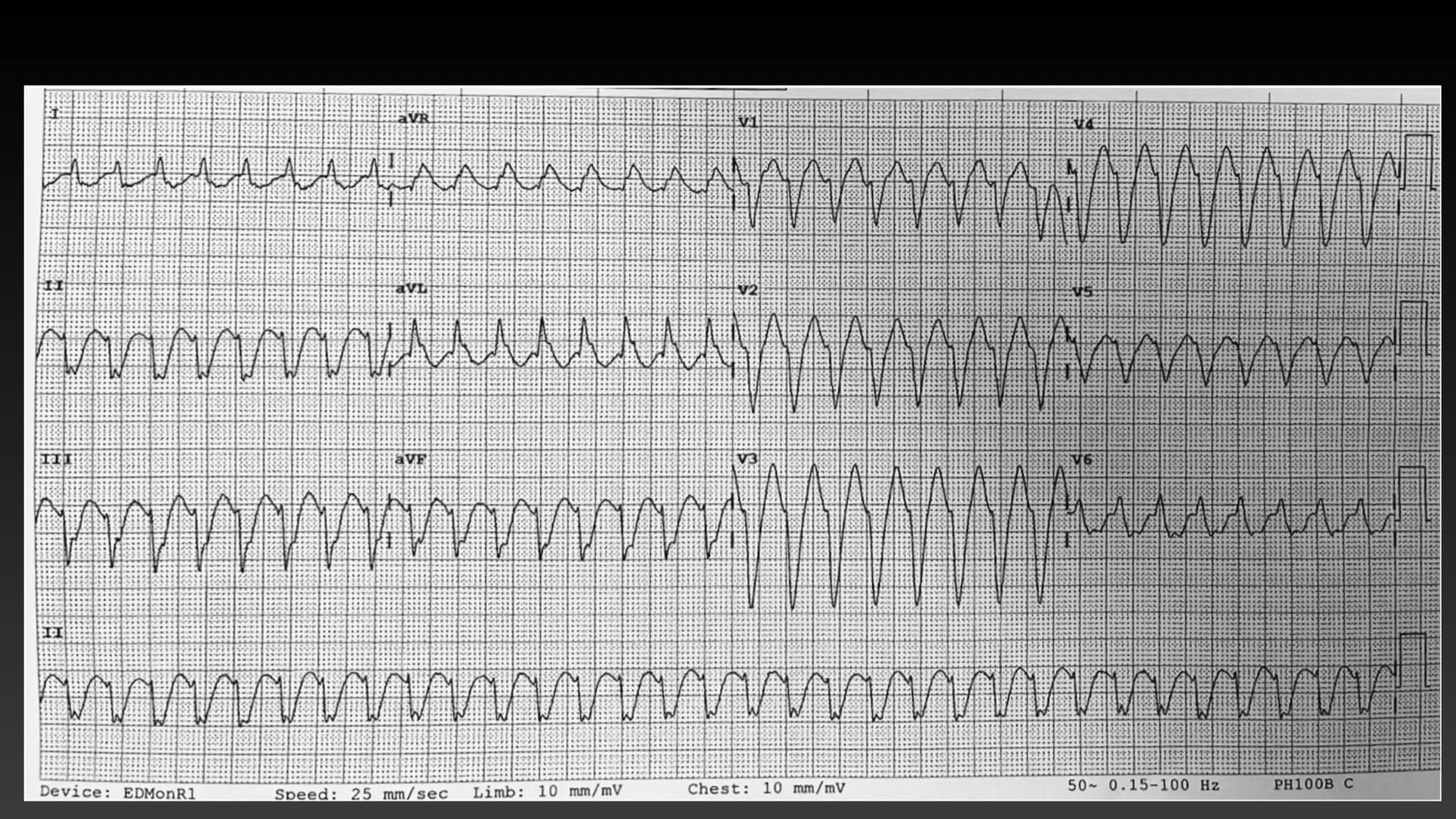 Broad Complex tachyarrhythmias.002.jpg