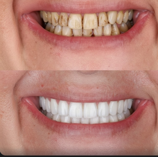 Porcelain Veneers vs Crowns: Which Is Right for Your Smile Makeover?