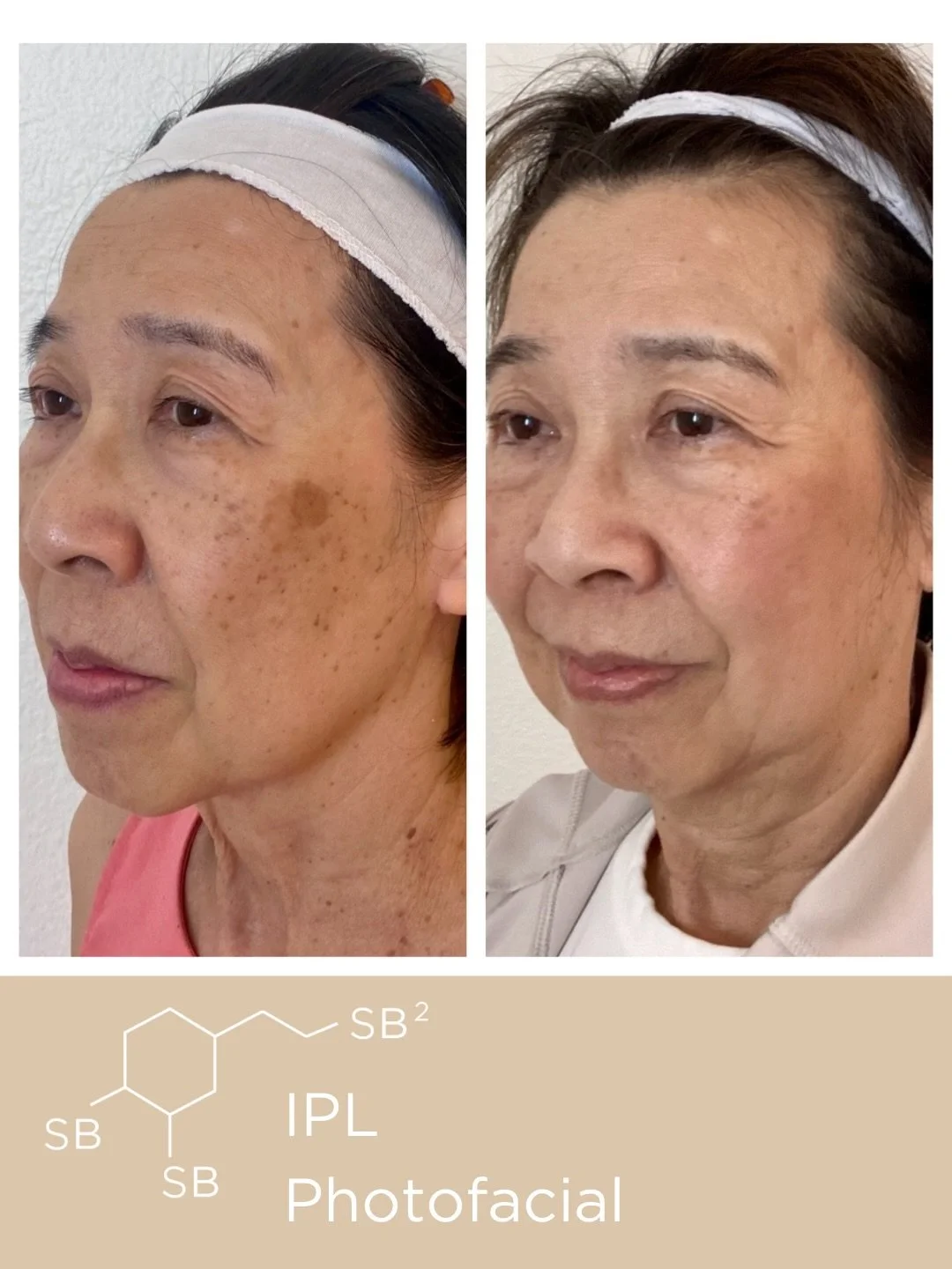 Swipe to see this before-and-after highlighting how IPL Photofacial visibly reduces sun damage and uneven pigmentation, revealing a brighter, clearer, and more even-toned complexion.✨

📲Call/text 818.222.9797 to book your IPL Photofacial.