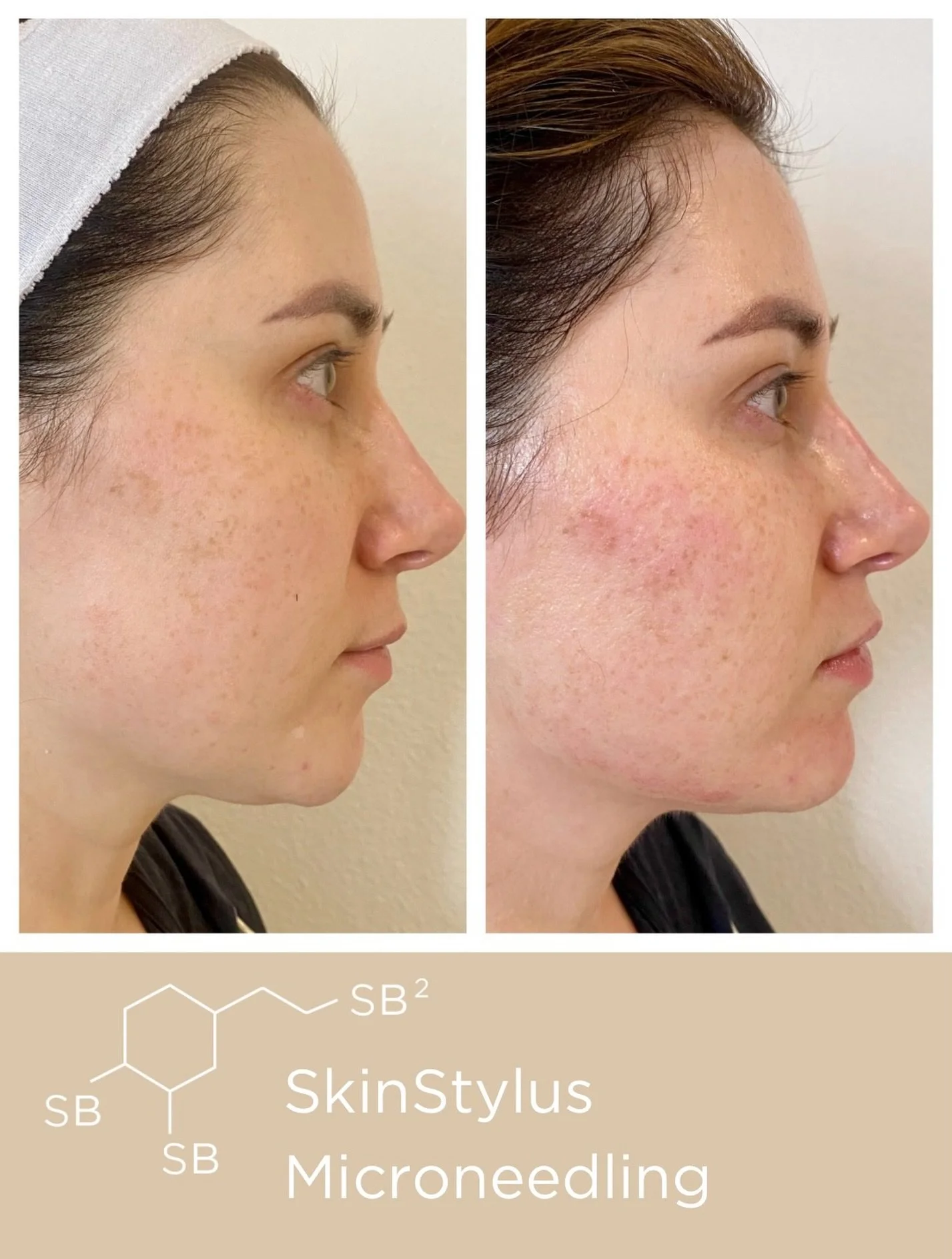What it looks like immediately after SkinStylus Microneedling with HA Serum.💉

SkinStylus Microneedling helps improve skin texture and tone by stimulating collagen production, resulting in smoother skin, reduced pigmentation and redness, and a more 