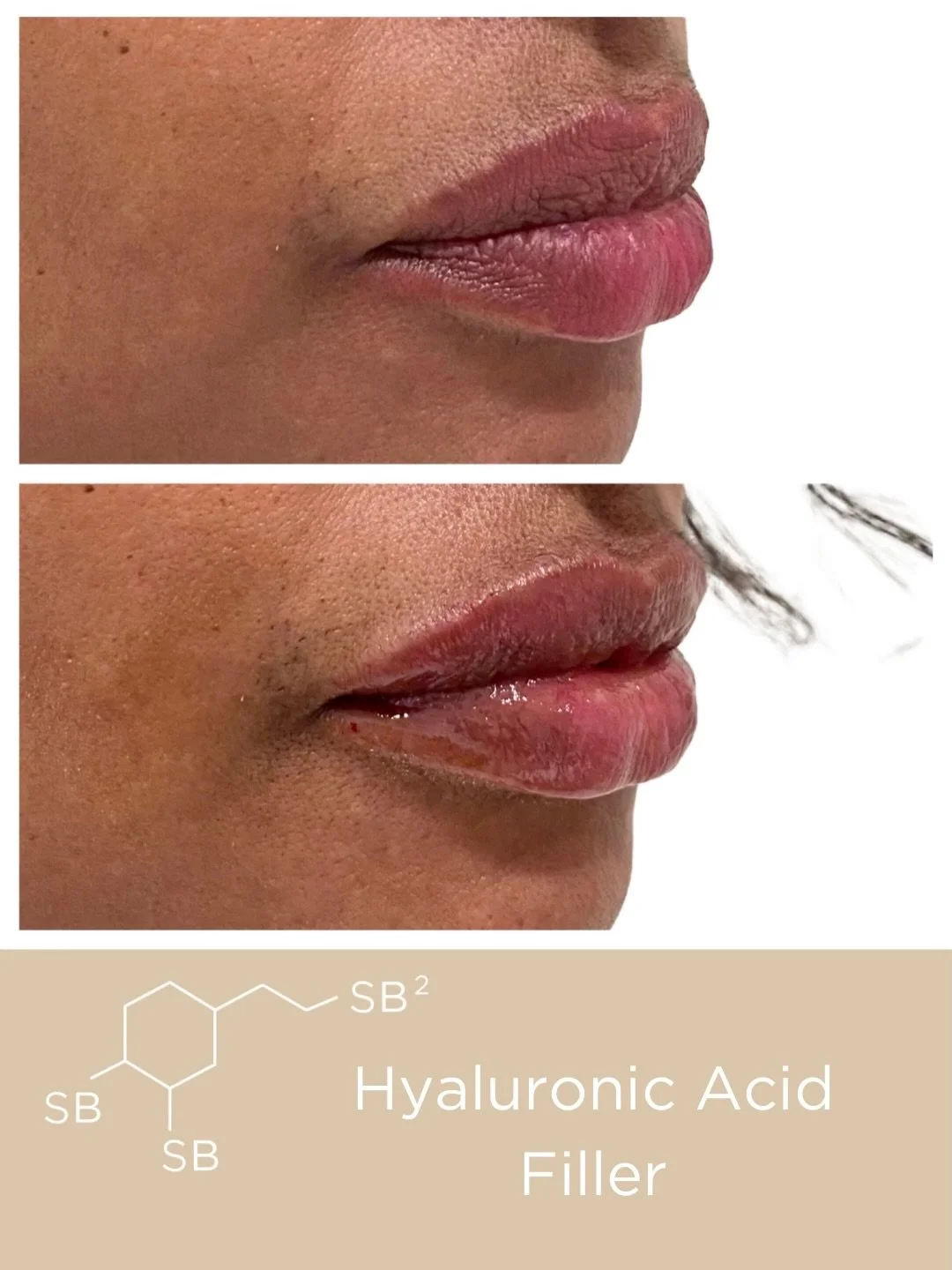 Before and immediately after Hyaluronic Acid Filler in the lips.💉

The Juvederm Collection of Hyaluronic Acid Fillers is designed to restore volume, smooth wrinkles, and enhance facial contours by attracting and retaining moisture in the skin.
📲Cal