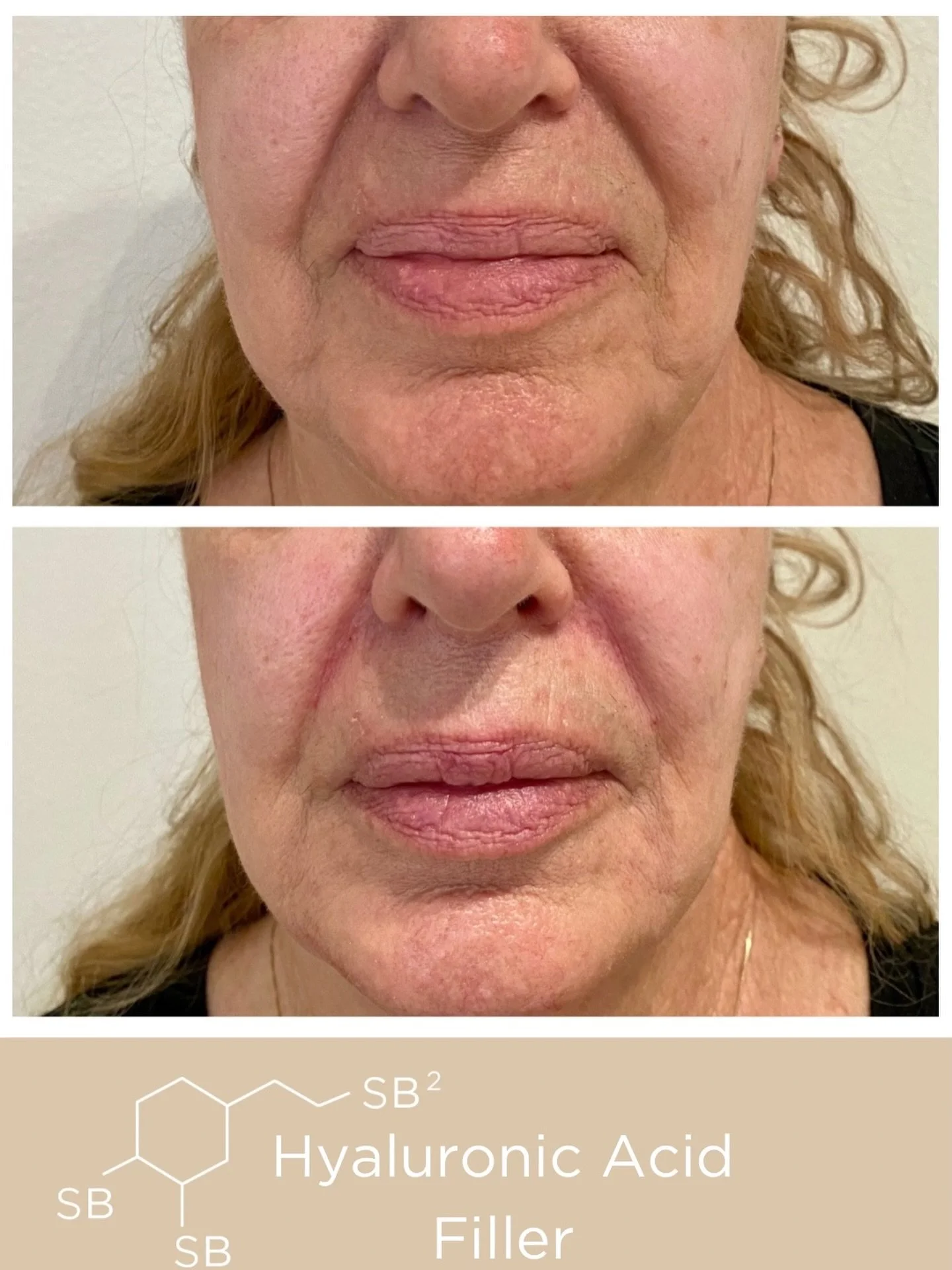 Before and immediately after Hyaluronic Acid Filler in the nasolabial folds and marionette lines.💉

The Evolysse Collection of Hyaluronic Acid Fillers is designed to restore volume, smooth wrinkles, and enhance facial contours by attracting and reta