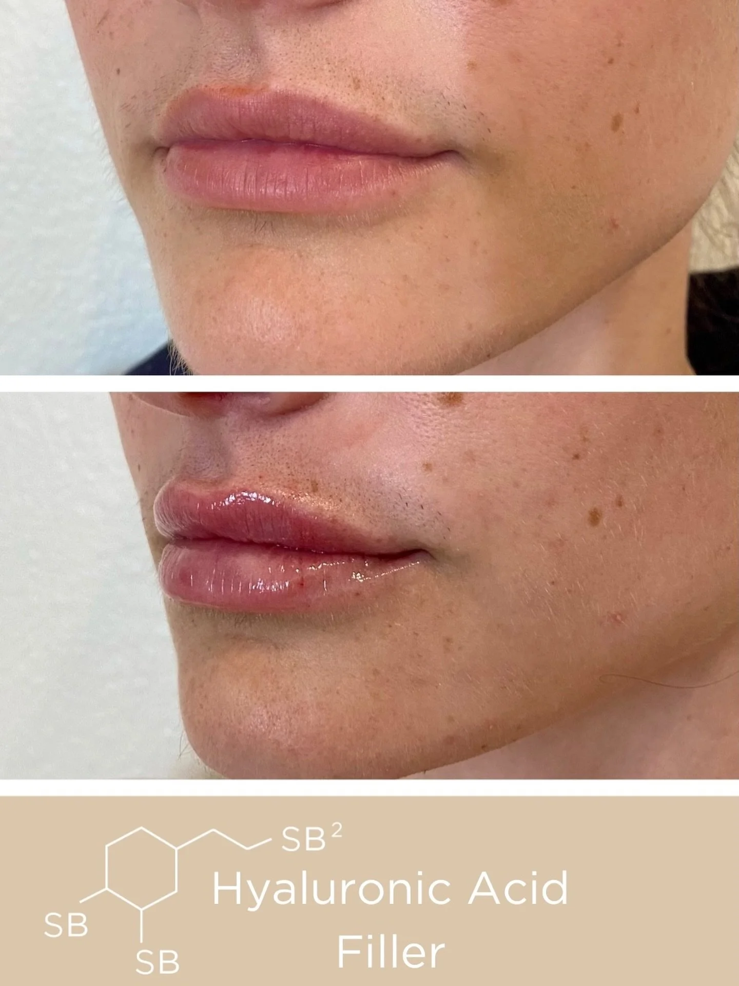 Before and immediately after Hyaluronic Acid Filler in the lips.💉

The Juvederm Collection of Hyaluronic Acid Fillers is designed to restore volume, smooth wrinkles, and enhance facial contours by attracting and retaining moisture in the skin.
📲Cal