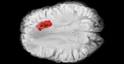 NIH-Funded Study: How Testosterone May Help Slow Brain Tumor Growth in Men