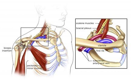 Cureus, Hydrodissection for the Treatment of Vascular Thoracic Outlet  Syndrome