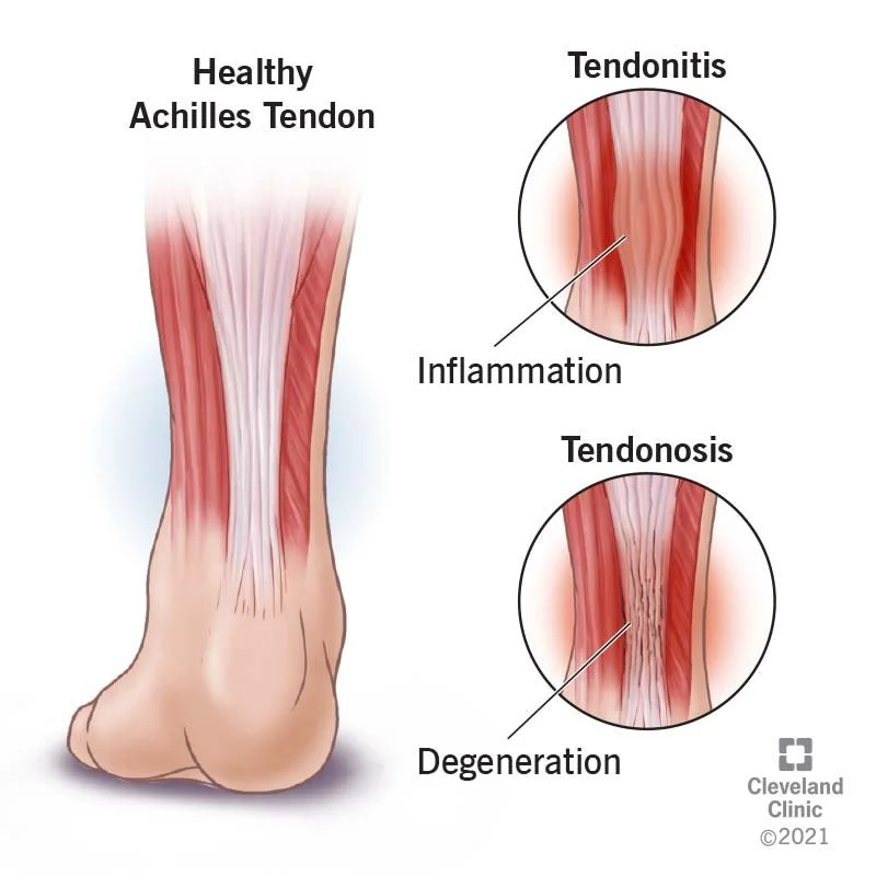 Chilliwack chiropractor low level laser therapy achilles tendon
