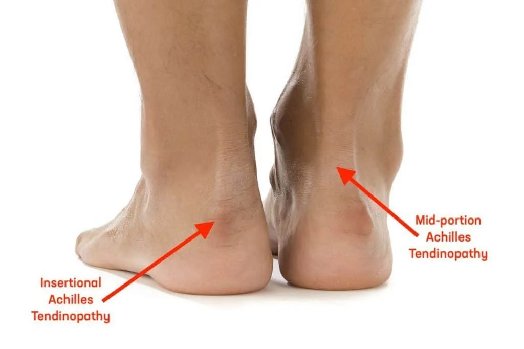 Chilliwack Chiropractor Tendinitis