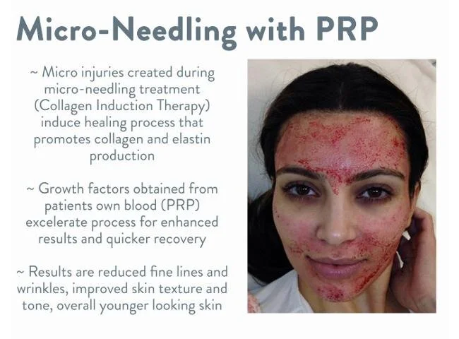 micro-needling-with-PRP-700x517.jpg.opt650x480o00s650x480.jpg