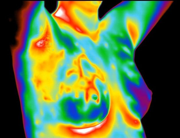 Breast Cancer Screening