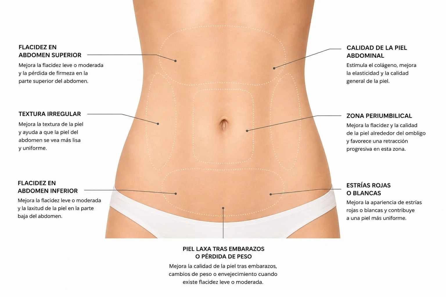 Morpheus8 para mejorar la flacidez abdominal leve o moderada
