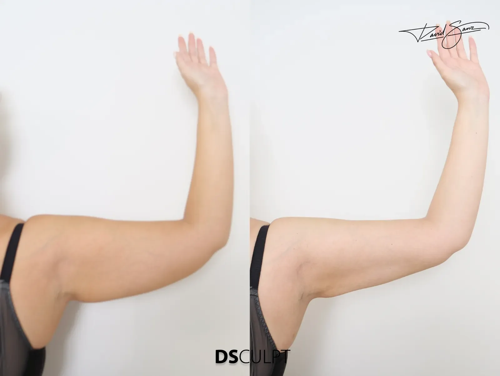 Resultado de reafirmación cutánea de los brazos mediante radiofrecuencia bipolar RFAL BodyTite.