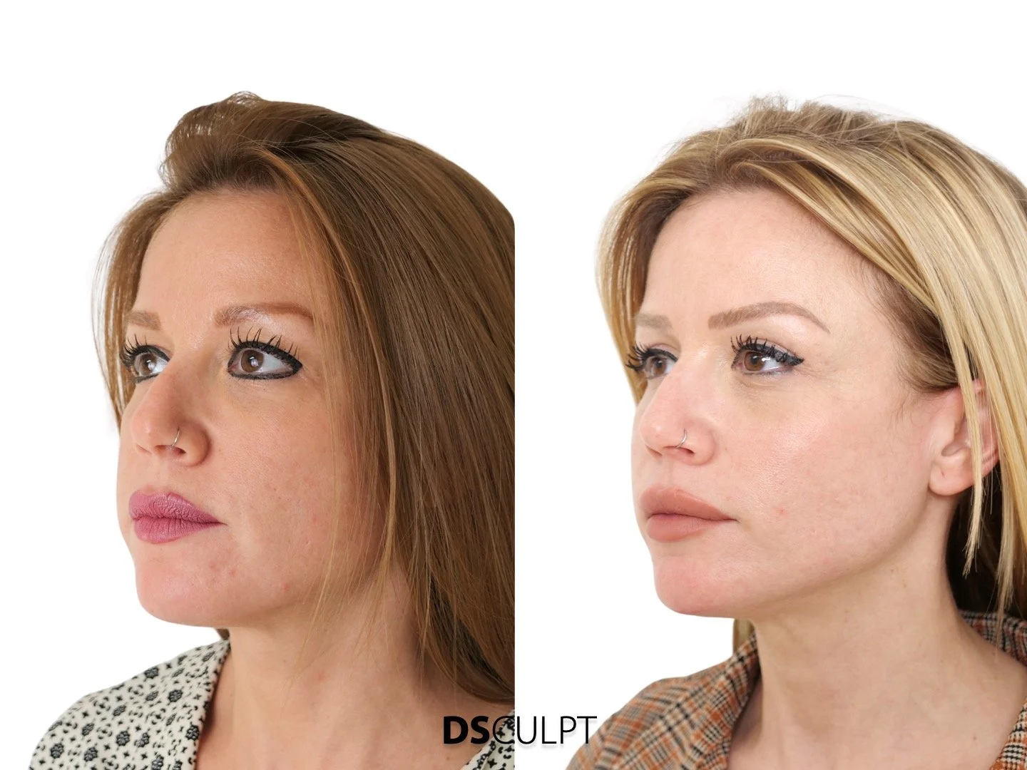Precio bichectomia y lipofilling facial en Barcelona en DSculpt Clinic